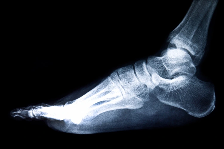 X-ray imaging of a person's foot.